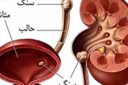 نشانه‌های ایجاد «سنگ مثانه» چیست؟
