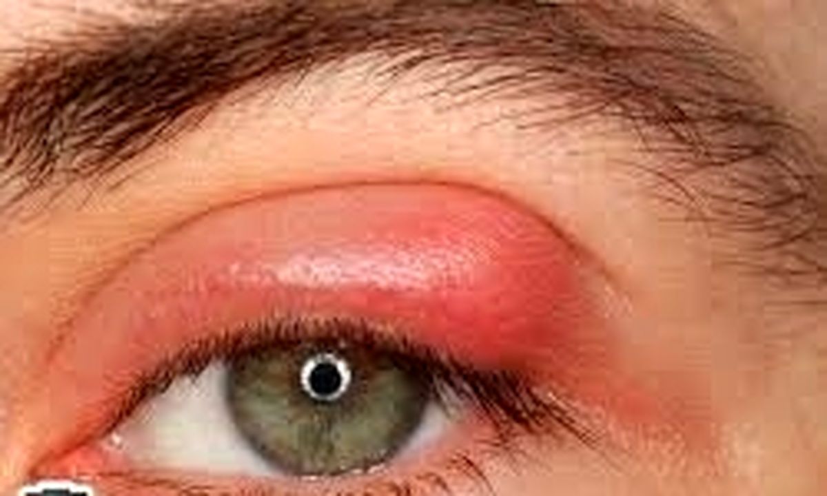 چگونه گل مژه را از بین ببریم؟