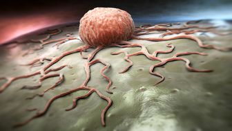 نشانه های سرطان در کودکان