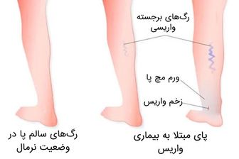 آیا درمان واریس دائمی و بدون بازگشت است؟