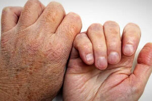 
چند درصد مردم هرگز جذام نمی گیرند؟
