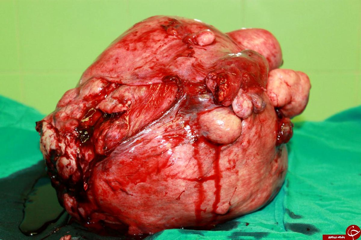 
خارج کردن توده 8 کیلوگرمی از شکم خانم 50 ساله+ تصاویر
