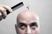 آشنایی با انواع روش های کاشت موی مدرن
