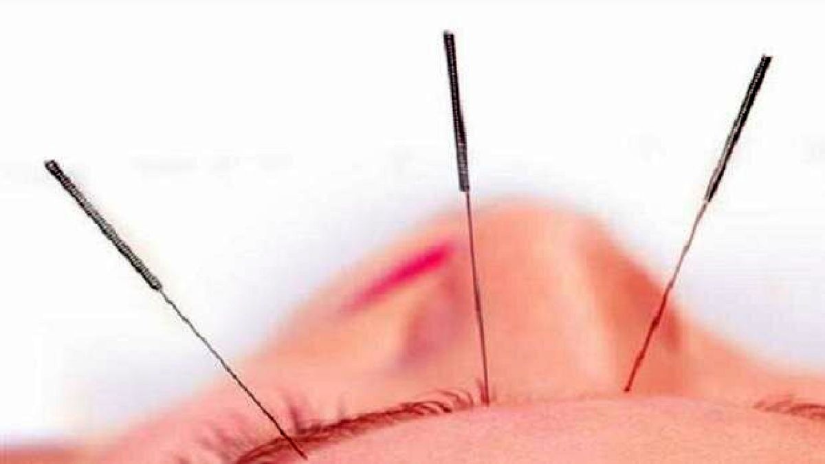 طب سوزنی در کاهش وزن موثر است
