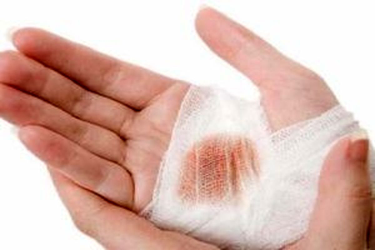توصیه‌های اورژانسی در سوختگی‌ها/ ناحیه سوخته را چه زمانی پانسمان کنیم؟

