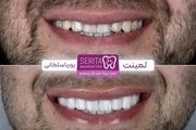 تفاوت کامپوزیت و لمینت با یکدیگر؟