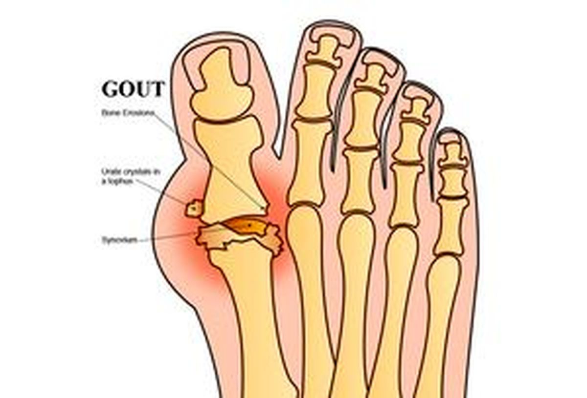همه چیز درباره بیماری نقرس +اینفوگرافیک