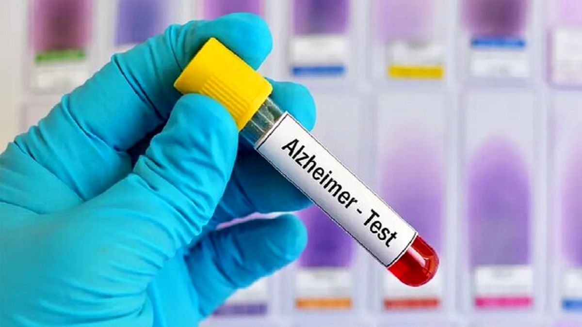 تشخیص آلزایمر از طریق نوعی آزمایش خون
