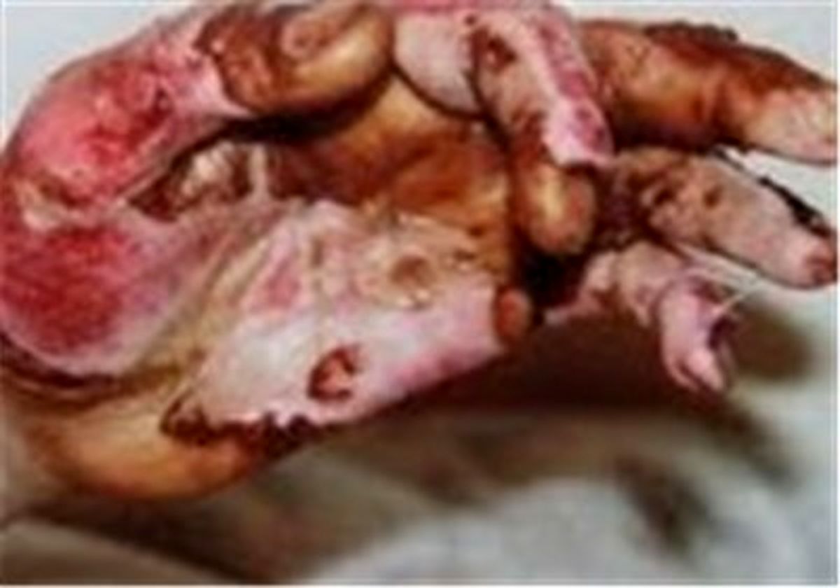 کاهش عمر مفید‏ ایرانیان به دلیل سوختگی