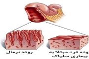 سلیاک، بیماری شایع اما ناشناخته
