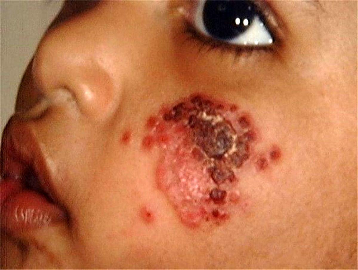 سالک روستایی یک بیماری بومی در مناطق گرمسیری کرمانشاه است