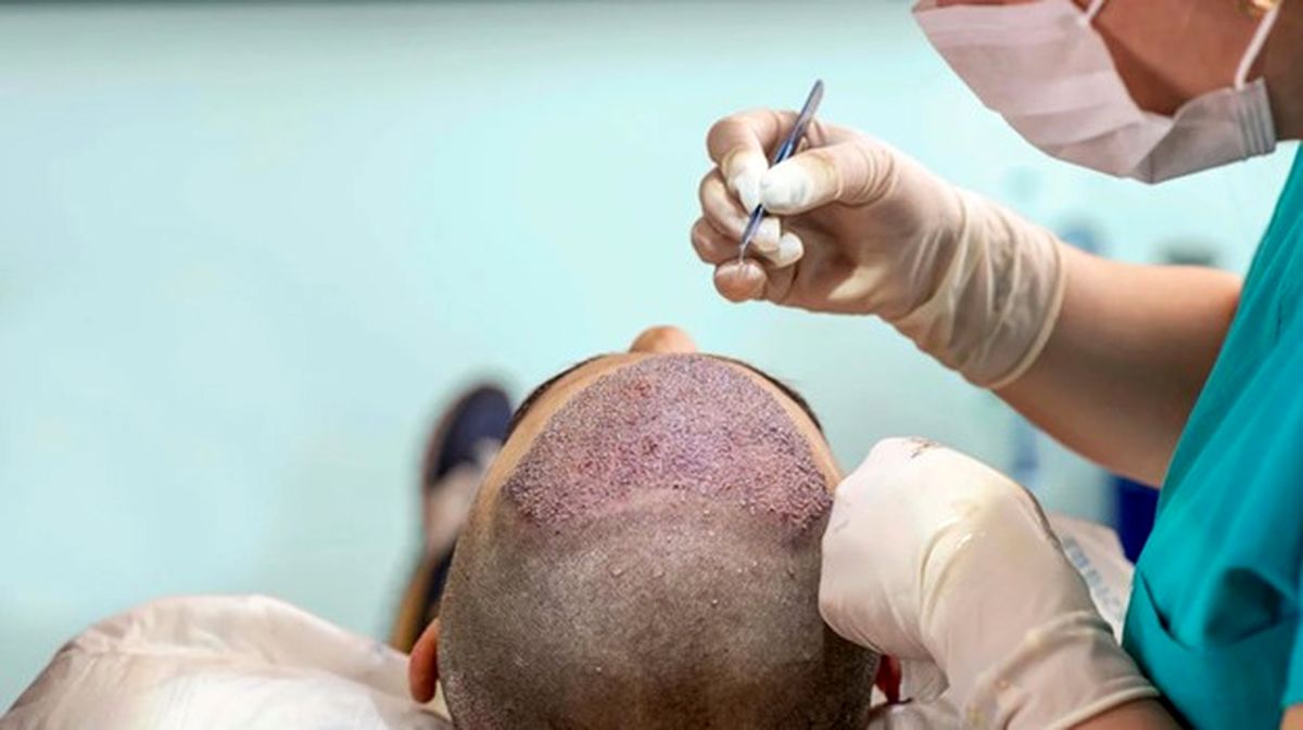 
چگونه مدرک کاشت مو بگیریم؟
