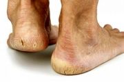 10 راه خلاصی از ترک پاشنه
