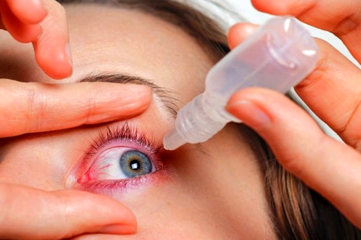 قرمزی چشم را چگونه درمان کنیم؟