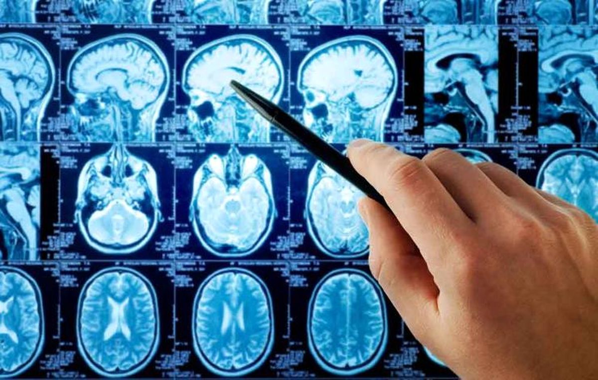 نشانه‌های وجود تومور در غده هیپوفیز