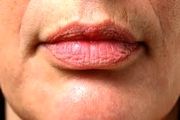 لب‌های شما از وضعیت سلامت‌تان می‌گویند!
