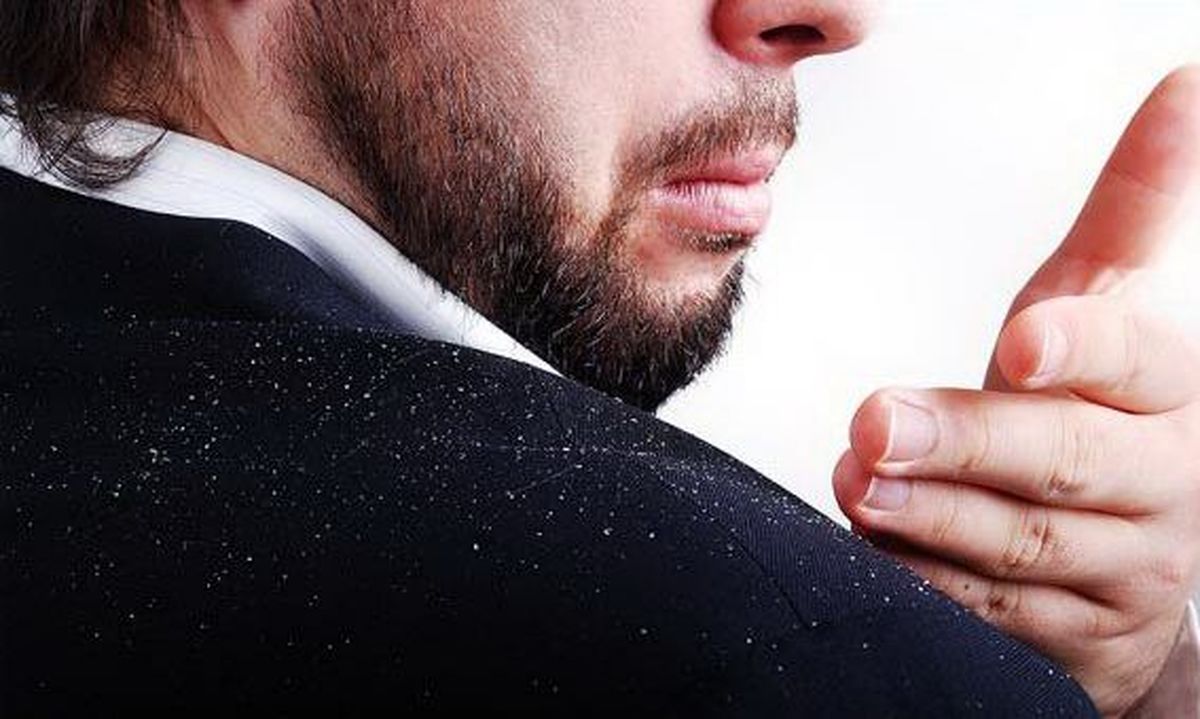 خود درمانی برای شوره سر ممنوع!