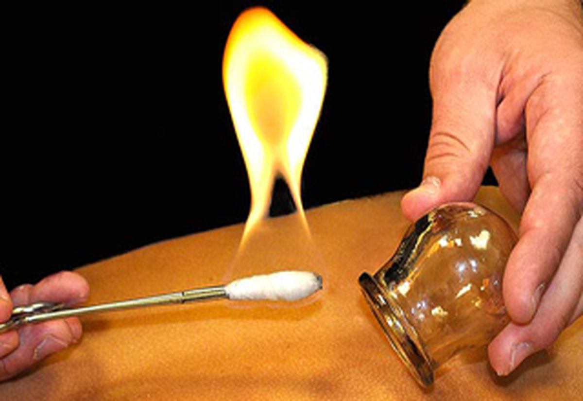 آیا می دانید بادکش درمانی چیست و چه فوایدی دارد؟