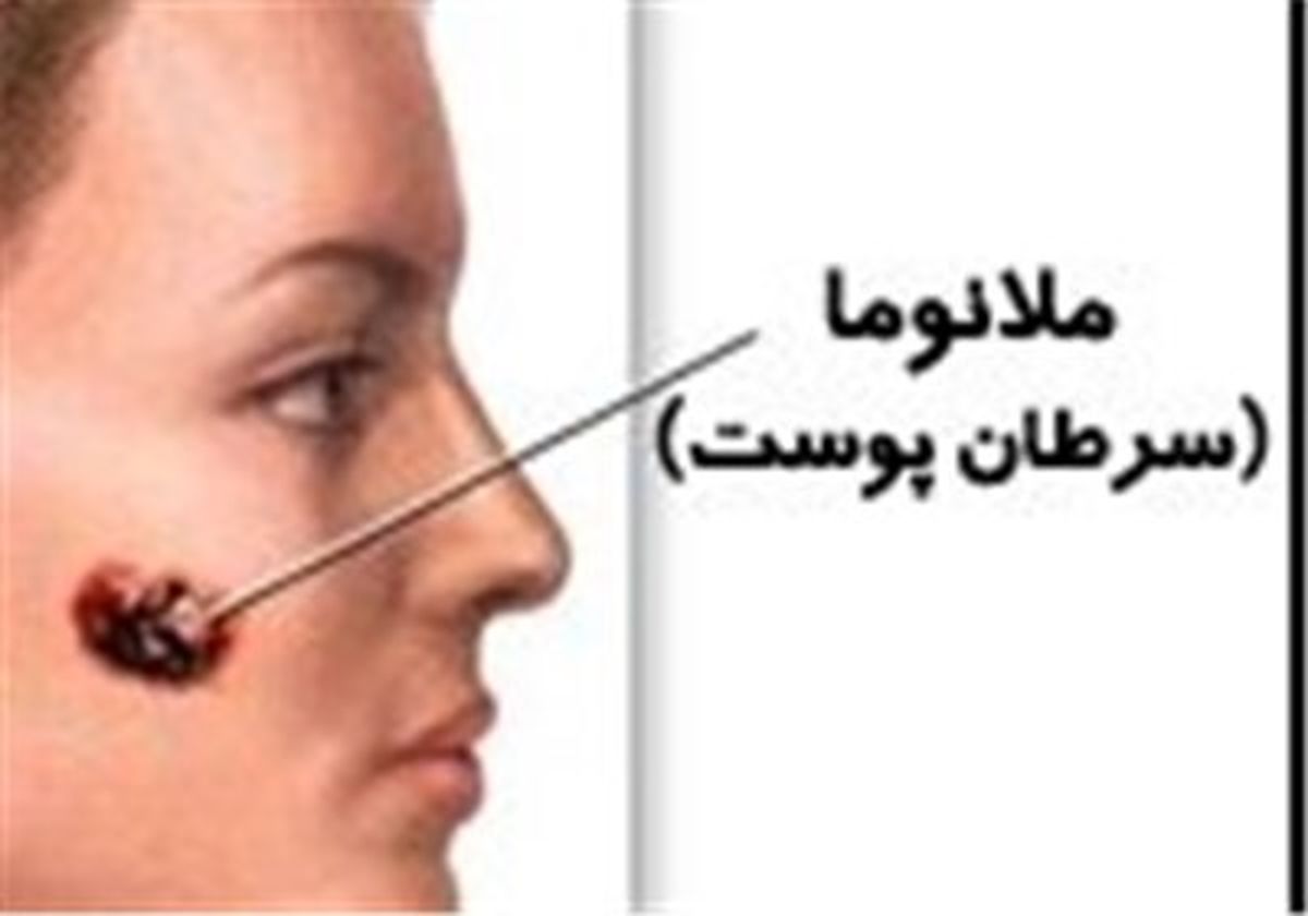 ساده‌ترین راه جلوگیری از سرطان بدخیم پوست