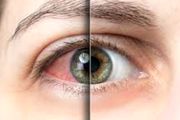 رابطه میان خشکی چشم و آسم چیست؟
