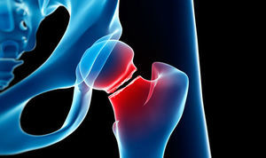 شایع‌ترین بیماری استخوان و مفاصل را بشناسید
