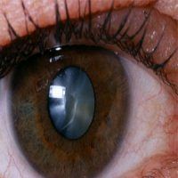 مواظب «مروارید بدن» باشید!
