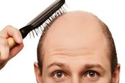 عوامل موثر بر طاسی زودهنگام