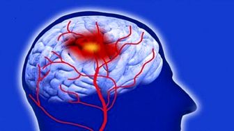 ابداع فناوری جدید برای رصد احتمال سکته مغزی
